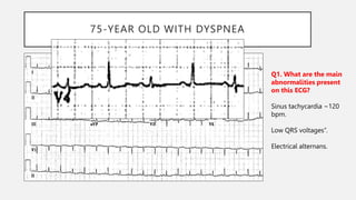 75-YEAR OLD WITH DYSPNEA
Q1. What are the main
abnormalities present
on this ECG?
Sinus tachycardia ~120
bpm.
Low QRS voltages’’.
Electrical alternans.
 
