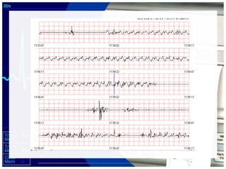 Fatal Four Rythms Lethal Cardiac Rhythms - Manual Defibrillation | PPT