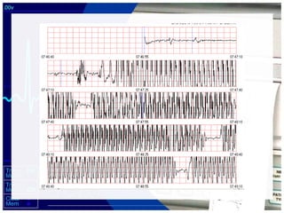 Lethal Cardiac Rhythms - Manual Defibrillation | PPT