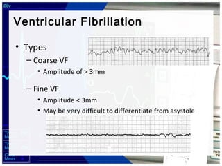 Lethal Cardiac Rhythms - Manual Defibrillation | PPT