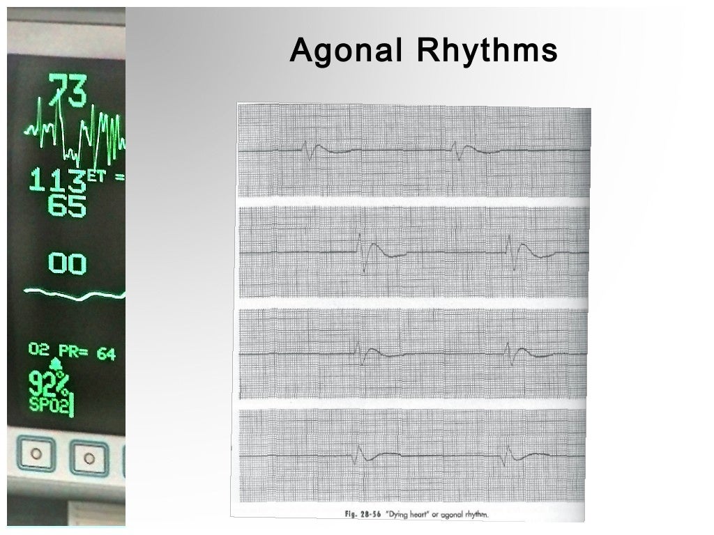 Lethal Cardiac Rhythms Manual Defibrillation