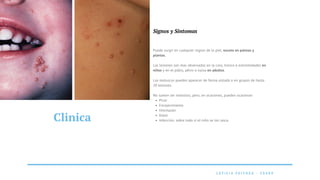 L E T I C I A F E I T O Z A - 2 0 4 8 9
Clinica
Signos y Sintomas
Picor
Enrojecimiento
Hinchazón
Dolor
Infección, sobre todo si el niño se los rasca.
Puede surgir en cualquier region de la piel, exceto en palmas y
plantas.
Las lesiones son mas observadas en la cara, tronco e extremedades en
niños y en el púbis, pênis o vulva en adultos.
Los moluscos pueden aparecer de forma aislada o en grupos de hasta
20 lesiones.
No suelen ser molestos, pero, en ocasiones, pueden ocasionar:
 