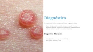 Diagnóstico
Biopsia de la piel o coloracion del material colectado de la lesion,
demuestra cuerpos de inclusion característicos, pero este procedimiento
suele ser necessario cuando no hay certeza diagnostica.
El diagnóstico del molusco contagioso se basea en la aparencia clínica;
Diagnóstico Diferencial
Foliculitis, milium y verrugas (lesiones < 2 mm)
Nevo de Spitz (lesiones > 2 mm)
 