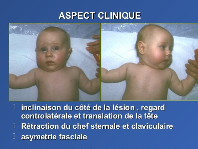 Le Torticoli Congenital Musculaire Ou Postural