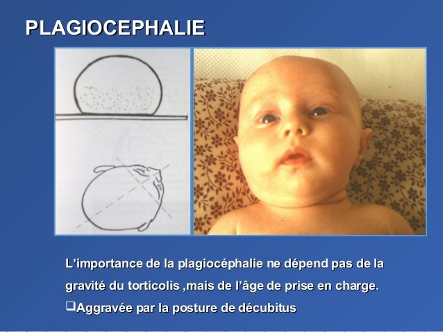 Le Torticoli Congenital Musculaire Ou Postural Le Torticoli Congenital Musculaire Ou Postural