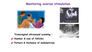 Monitoring ovarian stimulation
Transvaginal ultrasound scanning :
✔ Number & size of follicles
✔ Pattern & thickness of endometrium
 