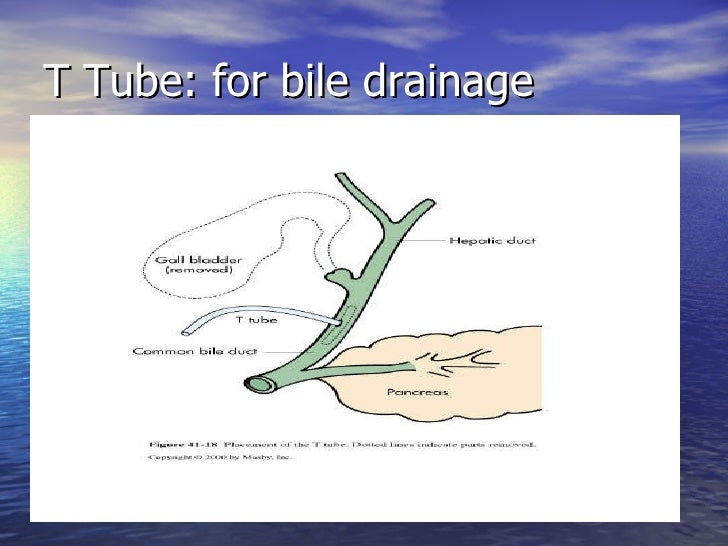let s go tubing understanding gi and gu t tube drain