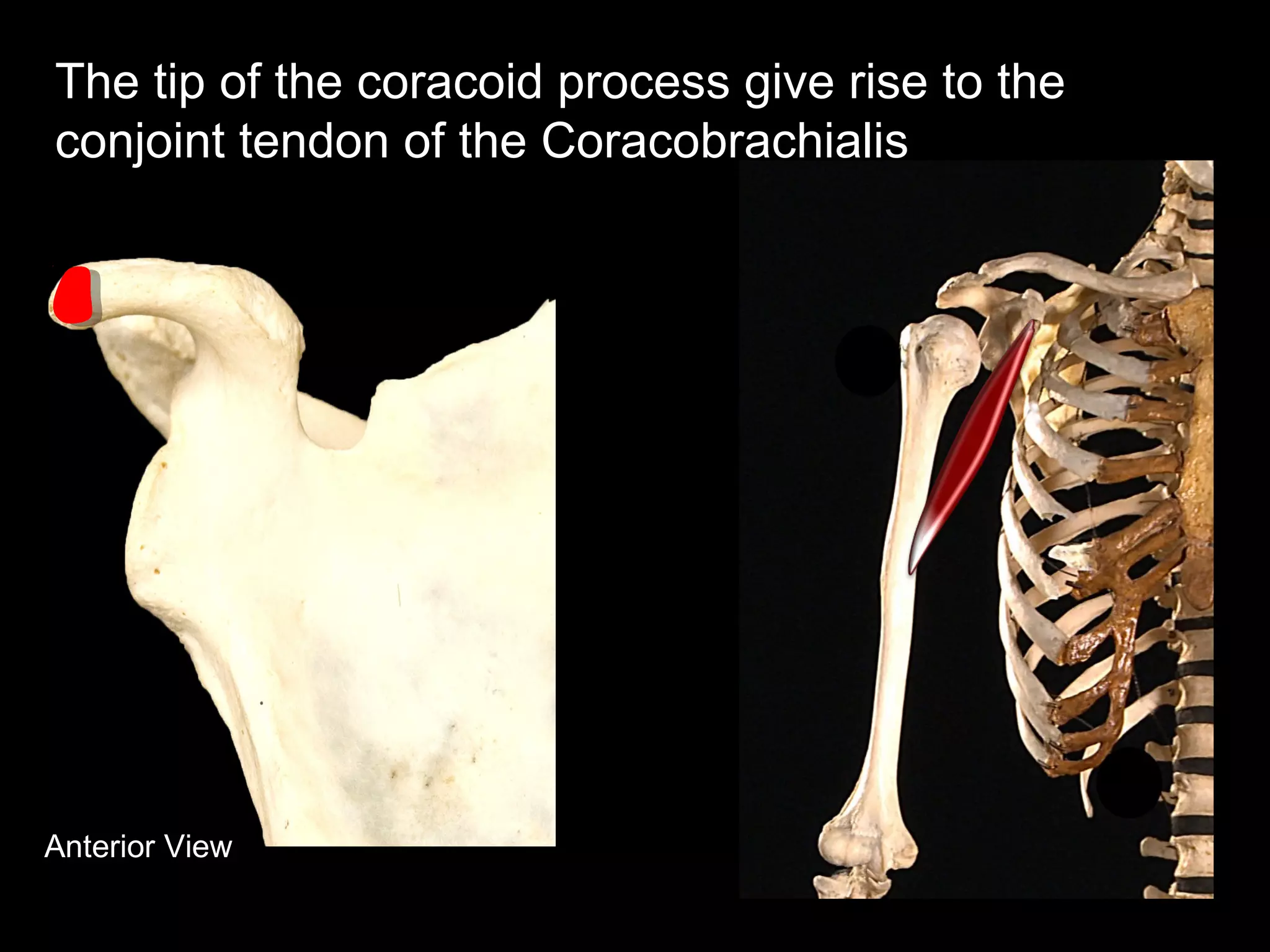 Anterior View
The tip of the coracoid process give rise to the
conjoint tendon of the Coracobrachialis
 