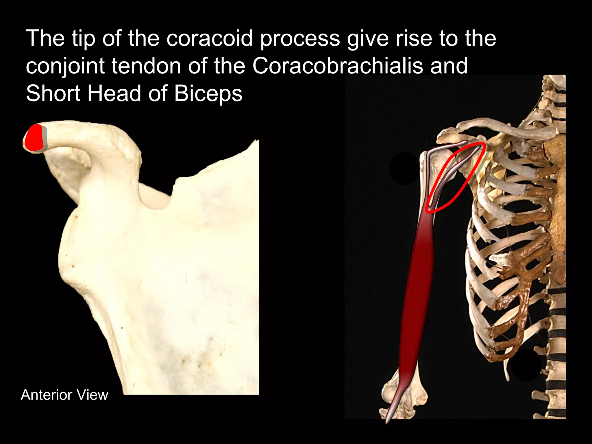 Anterior View
The tip of the coracoid process give rise to the
conjoint tendon of the Coracobrachialis and
Short Head of Biceps
 