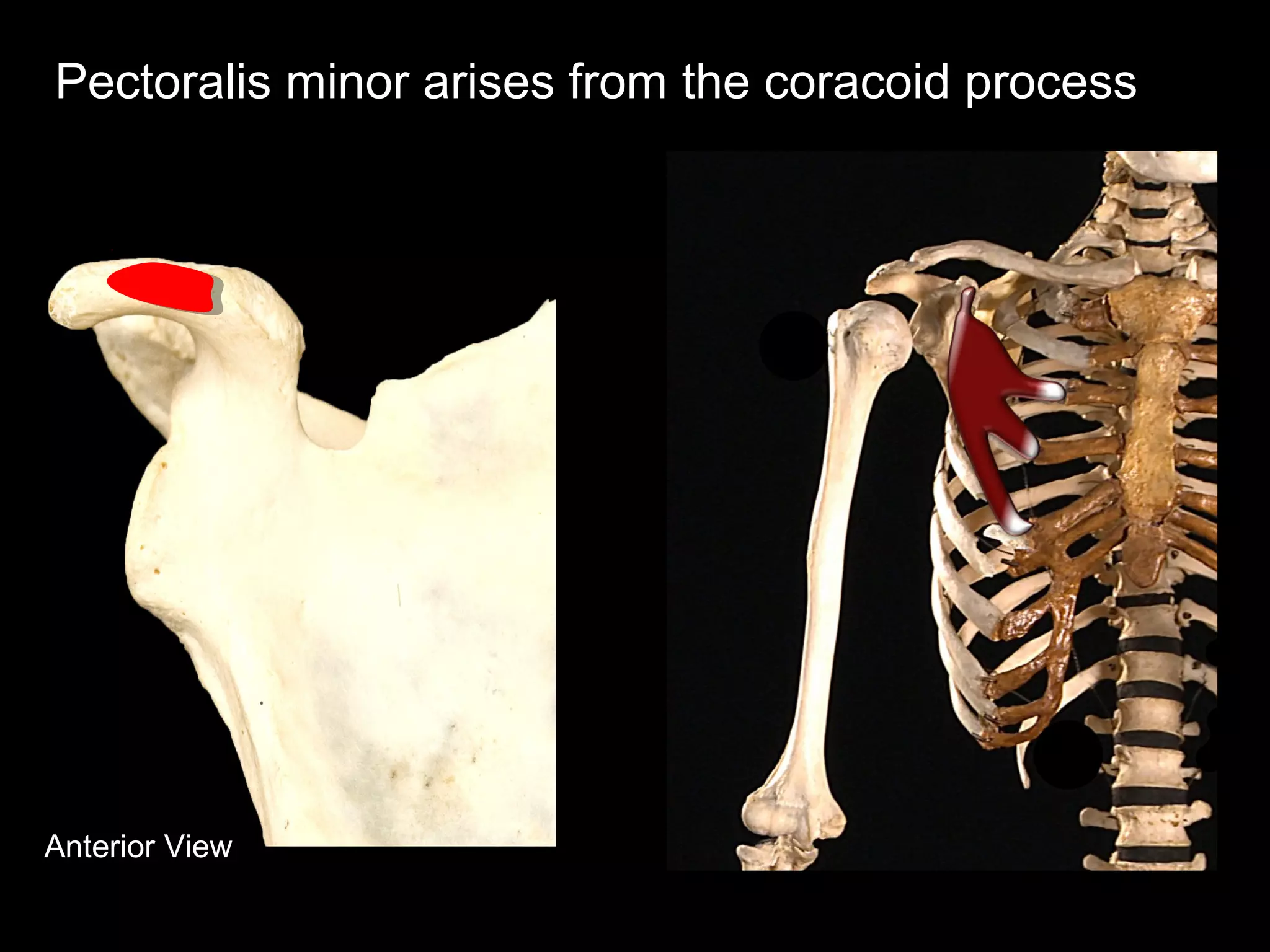 Anterior View
Pectoralis minor arises from the coracoid process
 