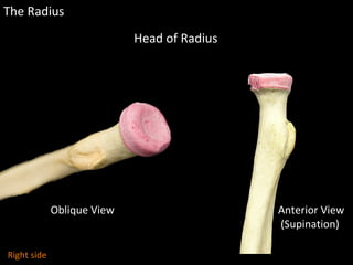 The Radius
Oblique View Anterior View
(Supination)
Head of Radius
Right side
 