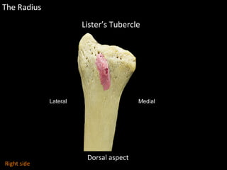 The Radius
Dorsal aspect
Lister’s Tubercle
Lateral Medial
Right side
 