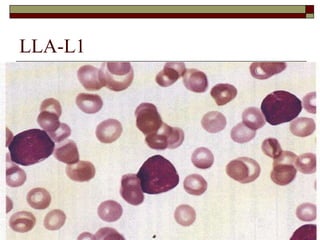 LLA-L1
 