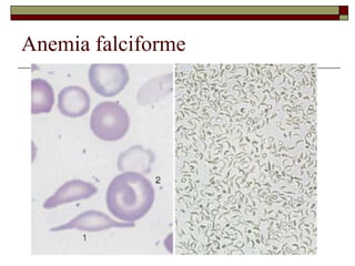 Anemia falciforme
 