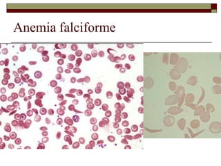 Anemia falciforme
 