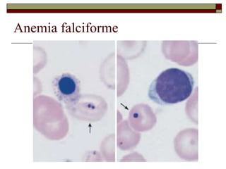 Anemia falciforme
 