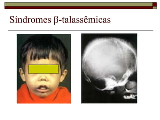 Síndromes β-talassêmicas
 