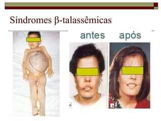 Síndromes β-talassêmicas
 