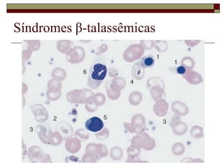 Síndromes β-talassêmicas
 