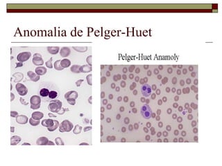 Anomalia de Pelger-Huet
 