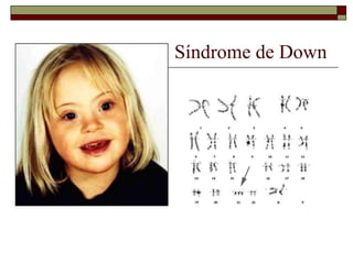 Síndrome de Down
 