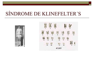 SÍNDROME DE KLINEFELTER´S
 