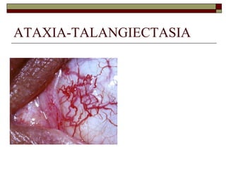 ATAXIA-TALANGIECTASIA
 