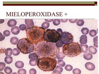 MIELOPEROXIDASE +
 