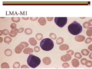 LMA-M1
 