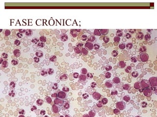 FASE CRÔNICA;
 