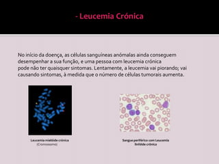 - Tipos de leucemia      Os tipos de leucemia são agrupados pela sua rapidez de desenvolvimento e agravamento da doença. A leucemia pode ser:  aguda (piora lentamente)   crónica (piora rapidamente)