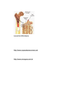 Leucemia bifenotipica




http://www.copacabanarunners.net




http://www.oncoguia.com.br
 