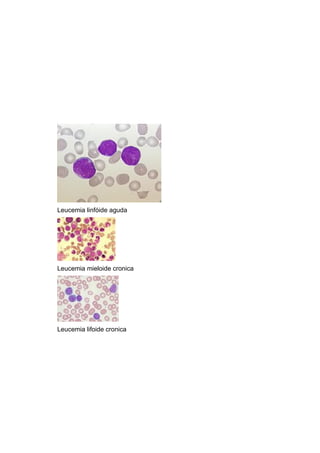 Leucemia linfóide aguda




Leucemia mieloide cronica




Leucemia lifoide cronica
 