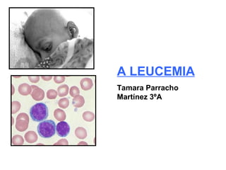 A LEUCEMIA
Tamara Parracho
Martínez 3ºA
 