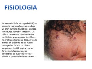 La leucemia linfocítica aguda (LLA) se
presenta cuando el cuerpo produce
un gran número de glóbulos blancos
inmaduros, llamados linfocitos. Las
células cancerosas rápidamente se
multiplican y reemplazan las células
normales en la médula ósea, el tejido
blando en el centro de los huesos
que ayuda a formar las células
sanguíneas. La LLA impide que se
formen células sanguíneas
saludables. Se pueden presentar
síntomas potencialmente mortales.

 