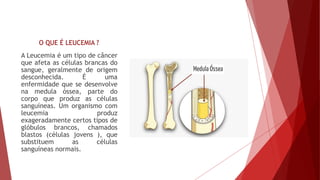 O QUE É LEUCEMIA ?
A Leucemia é um tipo de câncer
que afeta as células brancas do
sangue, geralmente de origem
desconhecida. É uma
enfermidade que se desenvolve
na medula óssea, parte do
corpo que produz as células
sanguíneas. Um organismo com
leucemia produz
exageradamente certos tipos de
glóbulos brancos, chamados
blastos (células jovens ), que
substituem as células
sanguíneas normais.
 