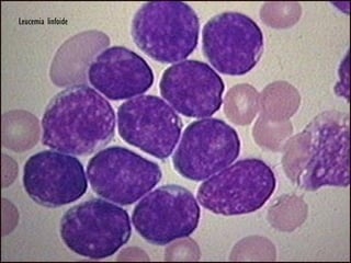 Leucemia linfoide 