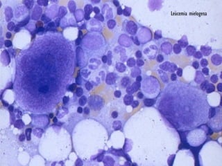 Leucemia mielogena   