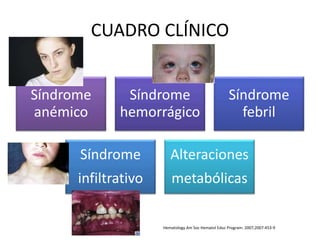 CUADRO CLÍNICO
Síndrome
anémico
Síndrome
hemorrágico
Síndrome
febril
Síndrome
infiltrativo
Alteraciones
metabólicas
Hematology Am Soc Hematol Educ Program. 2007;2007:453-9
 