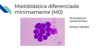 Mieloblástica diferenciada
mínimamente (M0)
No se observan
cuerpos de Auer
Núcleos redondos
 