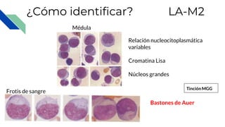 ¿Cómo identificar? LA-M2
Relación nucleocitoplasmática
variables
Cromatina Lisa
Núcleos grandes
Médula
Frotis de sangre
Bastones de Auer
Tinción MGG
 