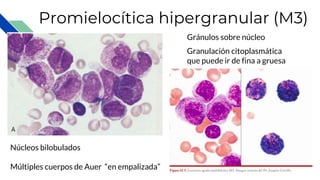 Promielocítica hipergranular (M3)
Granulación citoplasmática
que puede ir de fina a gruesa
Núcleos bilobulados
Múltiples cuerpos de Auer “en empalizada”
Gránulos sobre núcleo
 
