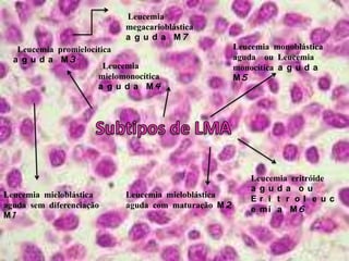 Leucemia   megacarioblástica aguda M7Leucemia monoblástica aguda  ou Leucemia monocítica aguda M5 Leucemia promielocítica aguda M3 Leucemia mielomonocítica aguda M4Subtipos de LMA Leucemia eritróide aguda ou Eritroleucemia M6Leucemia mieloblástica aguda sem diferenciação M1Leucemia mieloblástica aguda com maturação M2