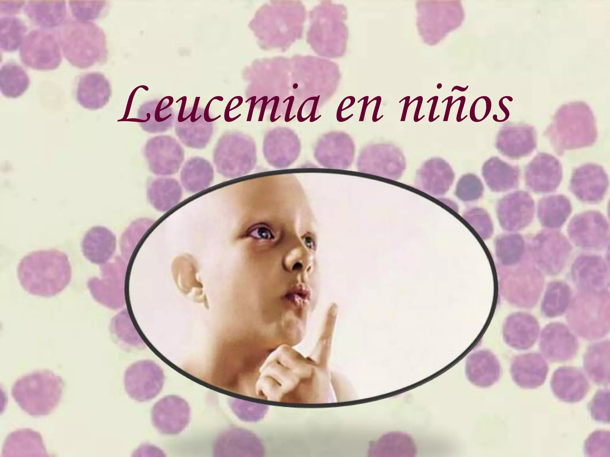 Leucemia en niños | PPTX