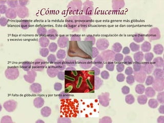 Leucemia en niños | PPTX