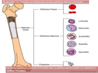 Las células sanguíneas se forman en la médula ósea. Los glóbulos blancos ayudan a su organismo a
combatir infecciones.
En personas con leucemia, la médula ósea produce glóbulos blancos anormales
 