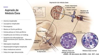 Aspirado de
Medula Ósea
• Anemia inexplicable
• Leucopenia inexplicable
• Pancitopenia
• Blastos en frontis periférico
• Celulas pilosas en frotis periférico
• Estadificación de linfoma no hodking
• Sospecha de enfermedad por
almacenamiento (Enf. Gaucher , Niemann-
Pick)
• Adenopatia inexplicada
• Hepatoesplenomegalia inexplicada
• Masa mediastinal anterior
• Fiebre de origen desconocido
JAMA, 28 de enero de 2009—Vol. 301, núm
 
