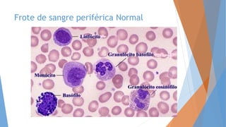 Frote de sangre periférica Normal
 