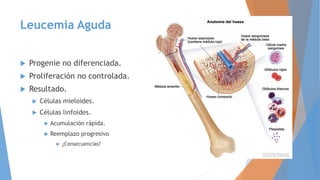 Leucemia Aguda
 Progenie no diferenciada.
 Proliferación no controlada.
 Resultado.
 Células mieloides.
 Células linfoides.
 Acumulación rápida.
 Reemplazo progresivo
 ¿Consecuencias?
 