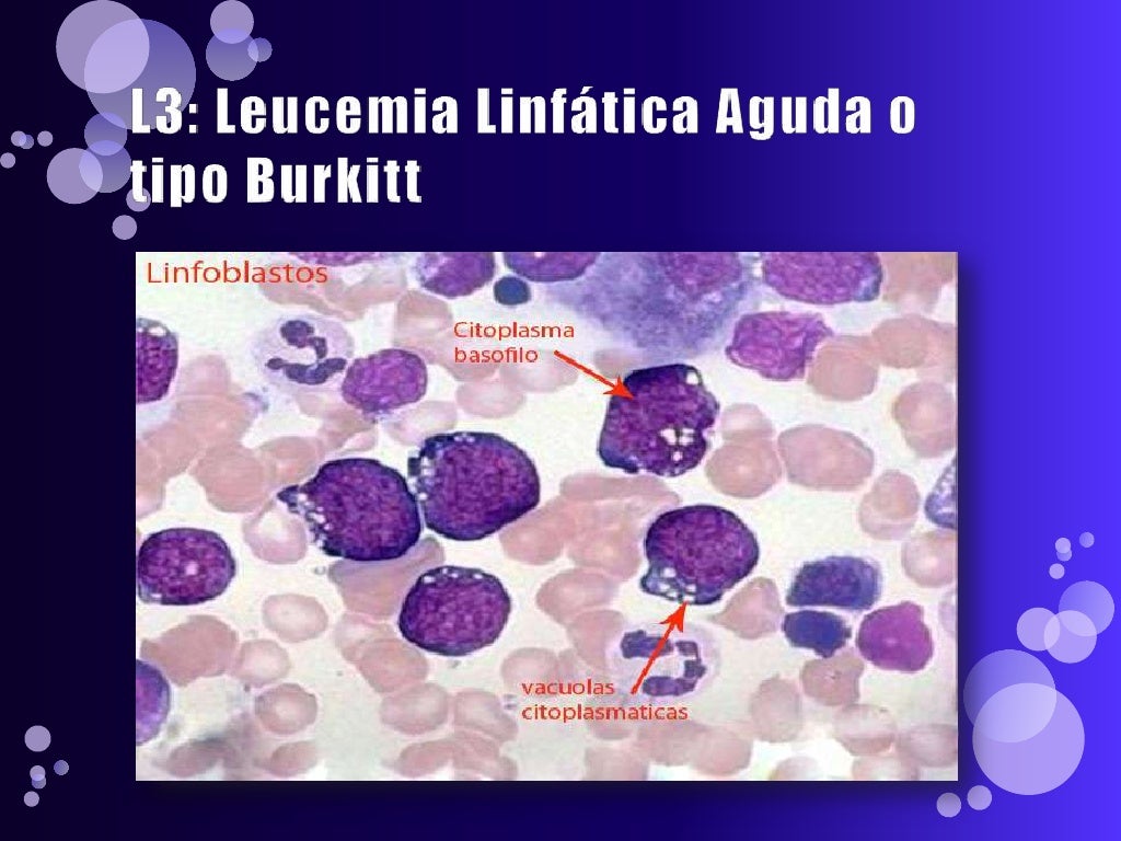 Leucemia linfatica aguda Leucemia linfatica aguda